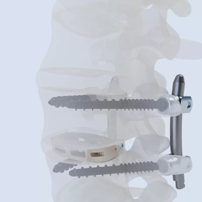 Oblique Lateral Interbody Fusion Cage (OLIF)