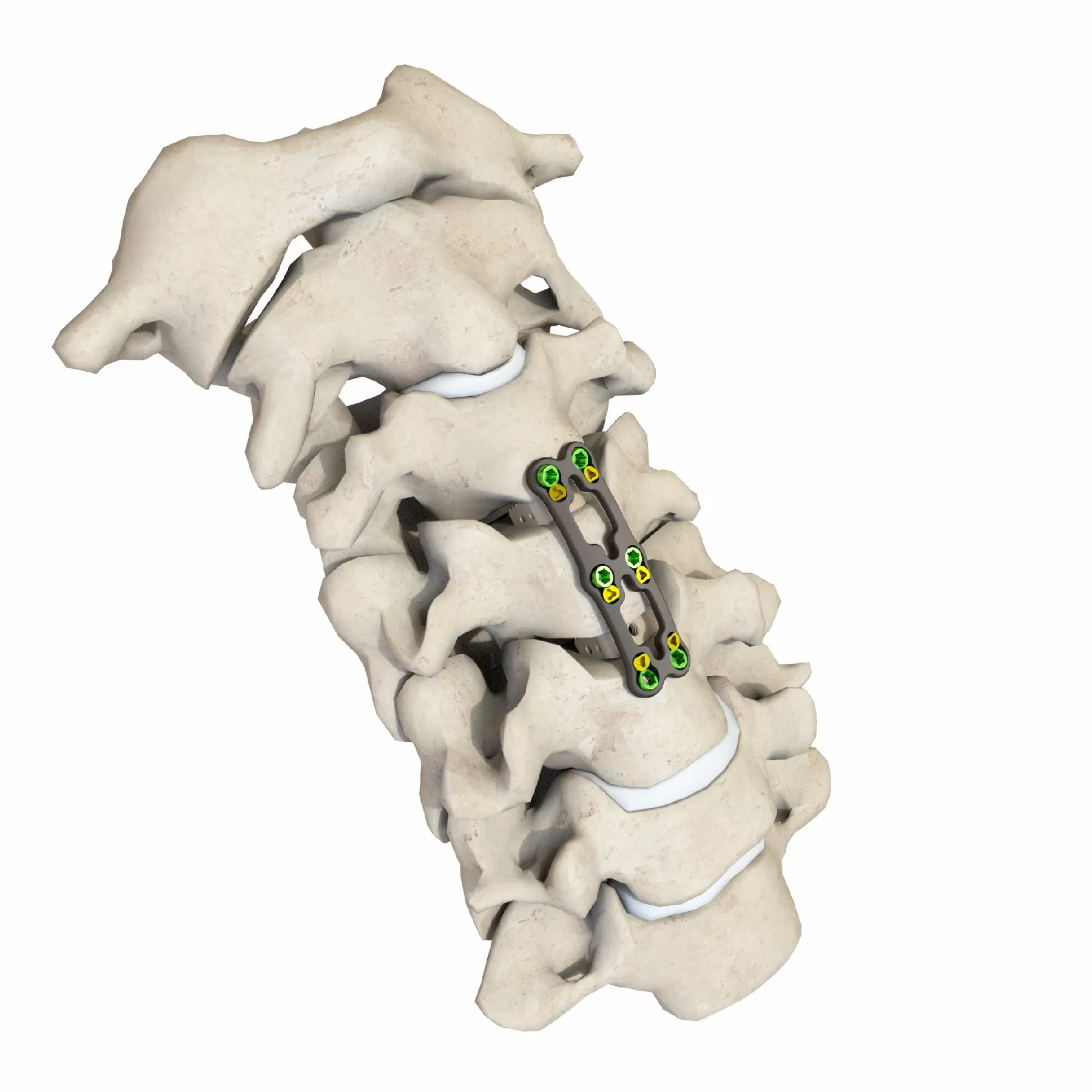 Anterior Cervical Plate – Type III