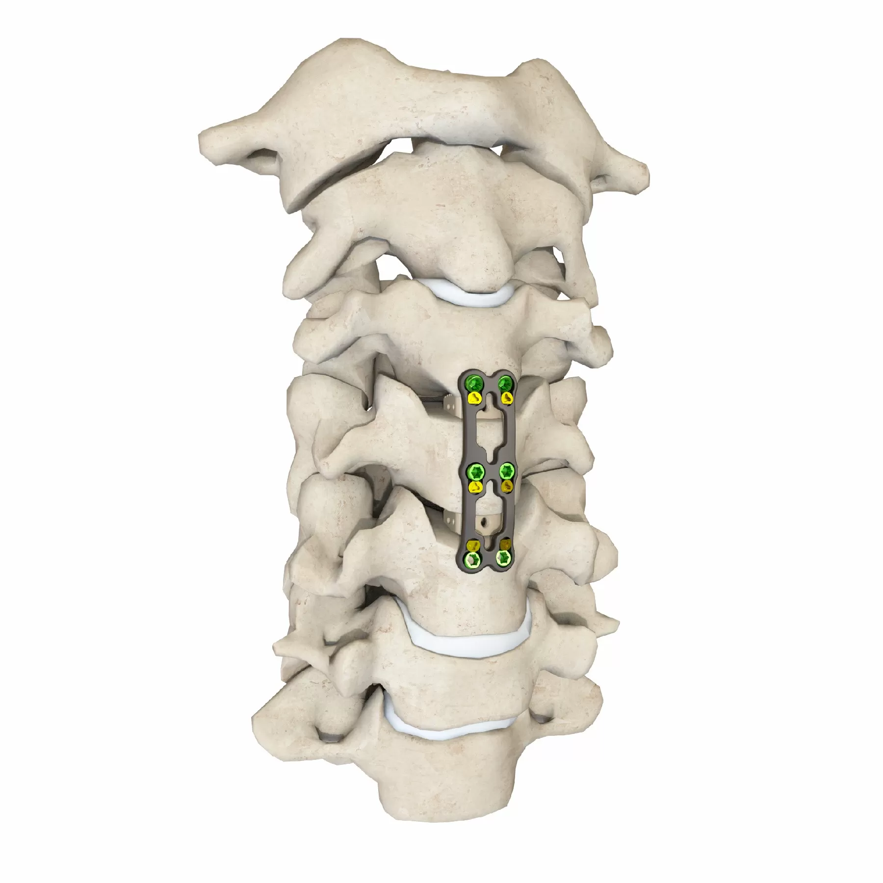 Anterior Cervical Plate – Type III