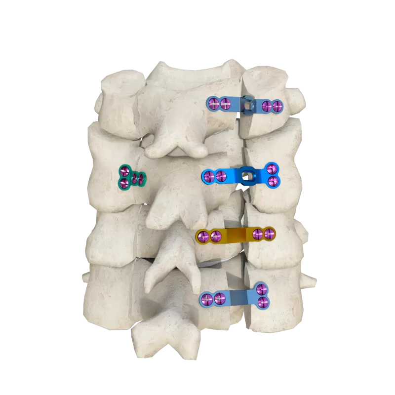 Hinged Titanium Laminoplasty Plate System