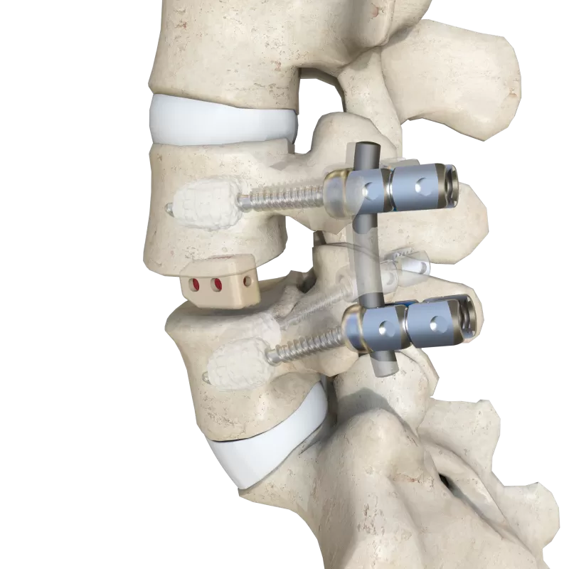 Thoracolumbar Posterior Pedicle Screw Fixation System
