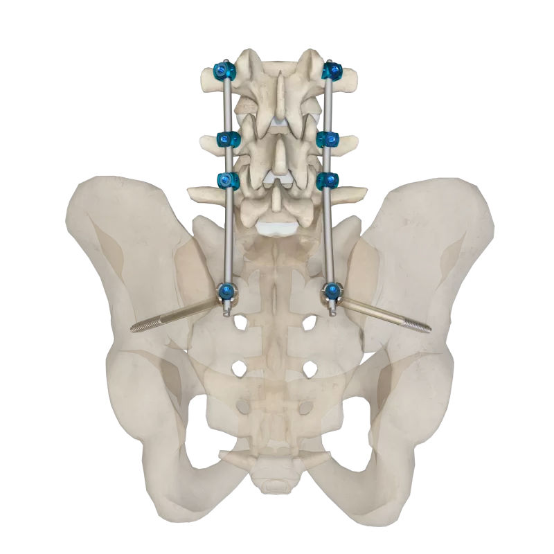 Thoracolumbar Posterior Pedicle Screw Fixation System