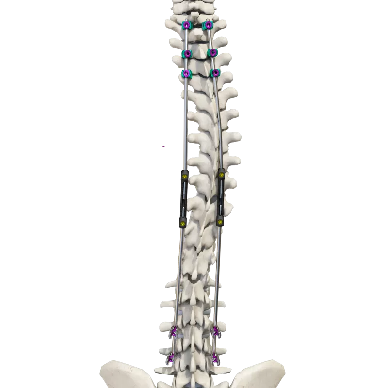 Thoracolumbar Posterior Pedicle Screw Fixation System