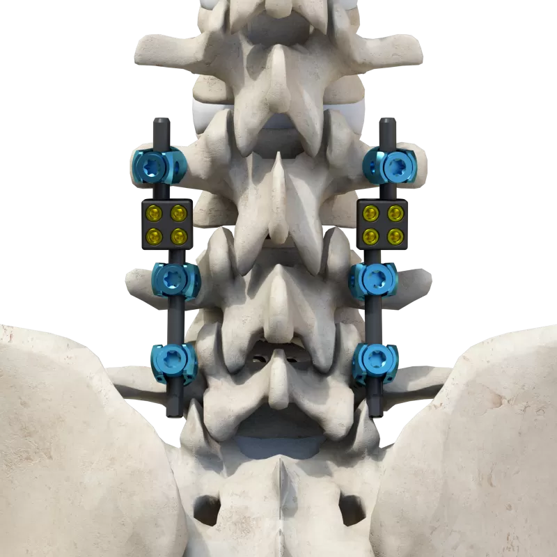 CoCrMo Thoracolumbar Posterior Screw-Rod System 6.0