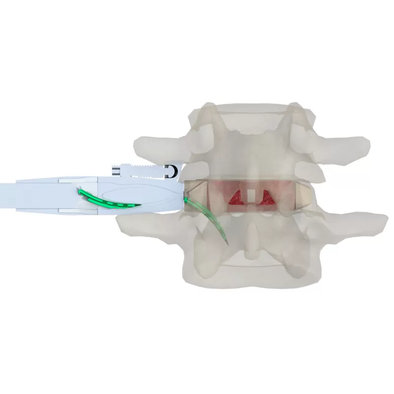 Self-Stabilizing Lumbar Interbody Fusion Cage 