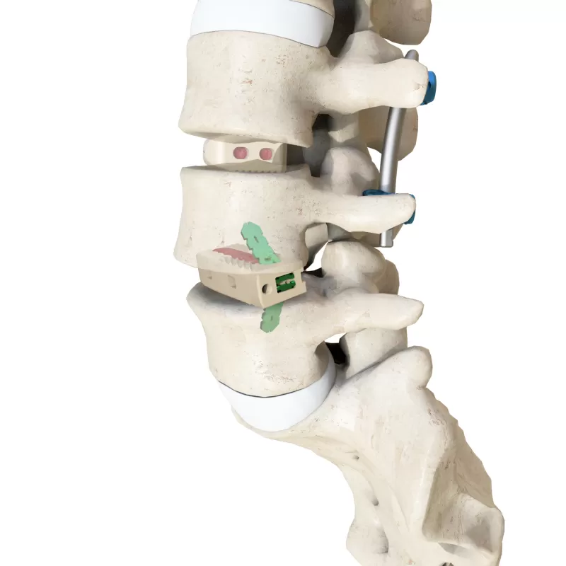 Self-Stabilizing Lumbar Interbody Fusion Cage 