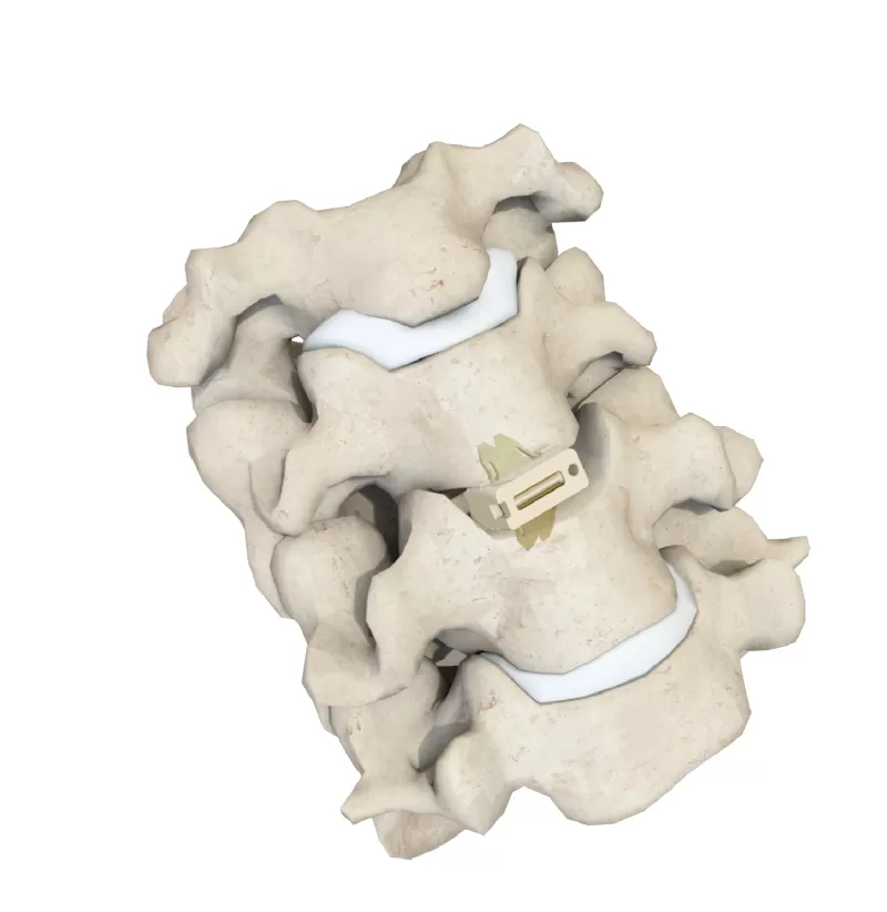 Cervical Interbody Fusion Cage Uni-C