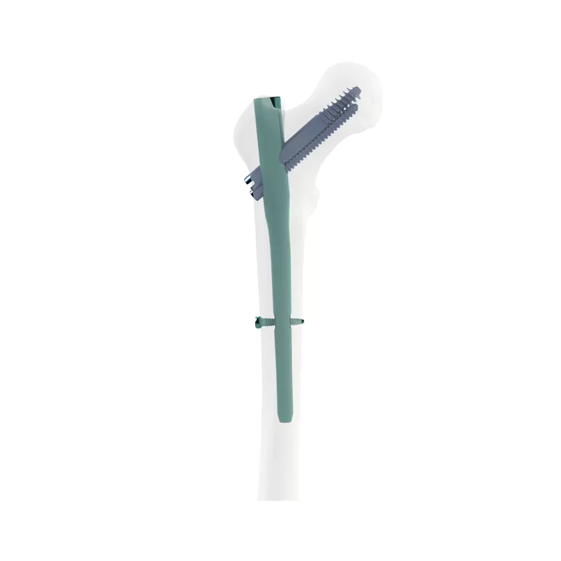 orthopedic implant, intramedllary nail, intramedllary nailing, im nail, im nailing, PFNA