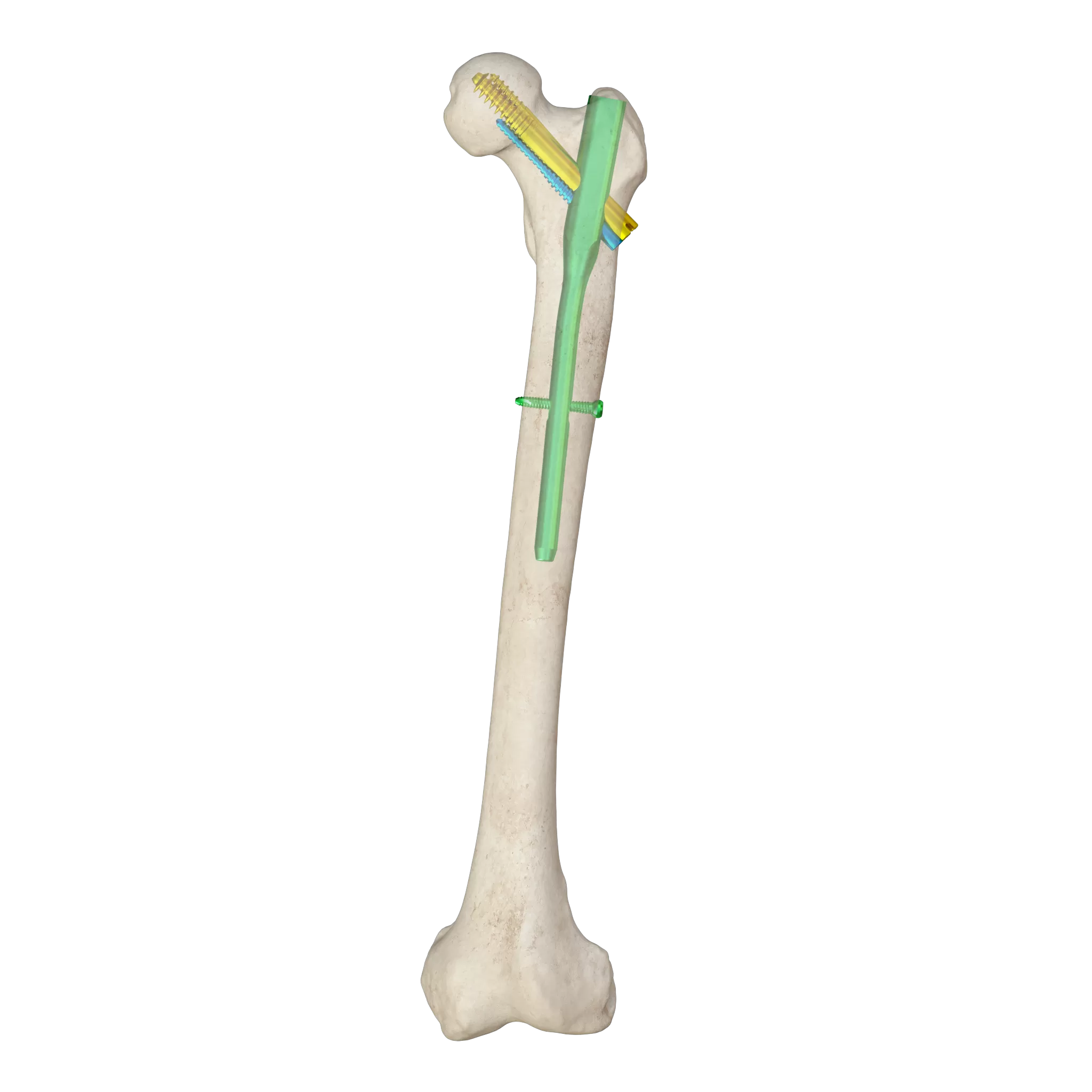 orthopedic implant, intramedllary nail, intramedllary nailing, im nail, im nailing, PFNA