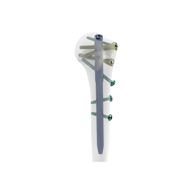 orthopedic implant, intramedllary nail, intramedllary nailing, im nail, im nailing, PFNA