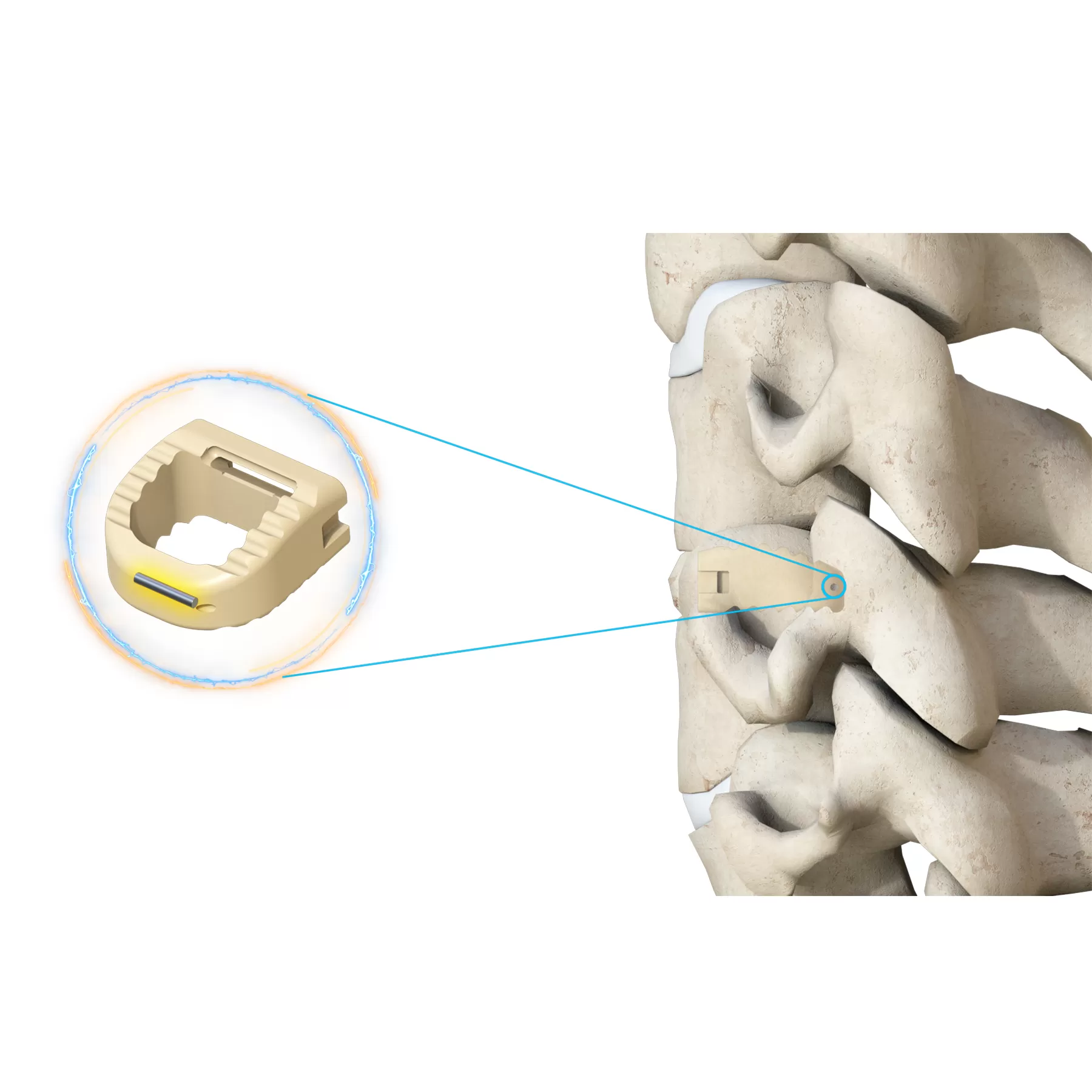 Cervical Interbody Fusion Cage (Insert-type)