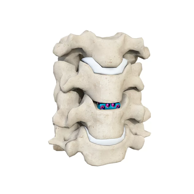 Cervical Interbody Fusion Cage (4 Screws)