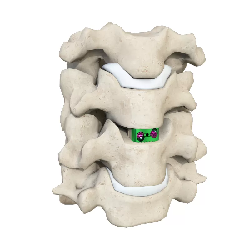 Cervical Interbody Fusion Cage (2 Screws)