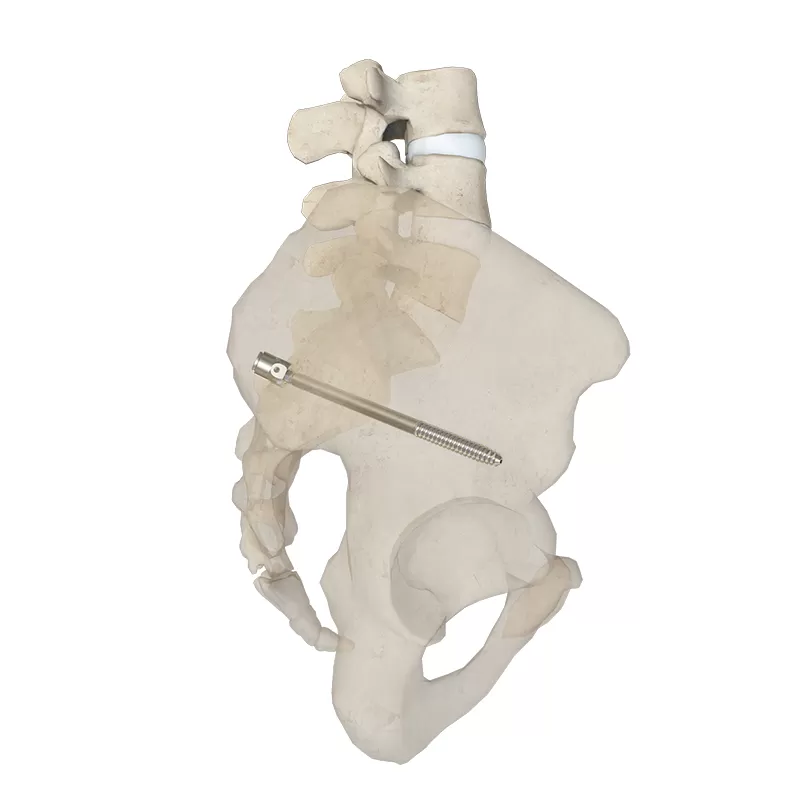 Iliac Screw for S2 Alar-Iliac Fixation Technique (5.5 system)