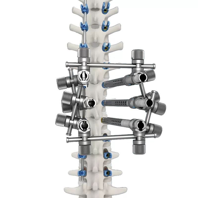 Uniplanar screws (6.0 system) For Spinal Deformity