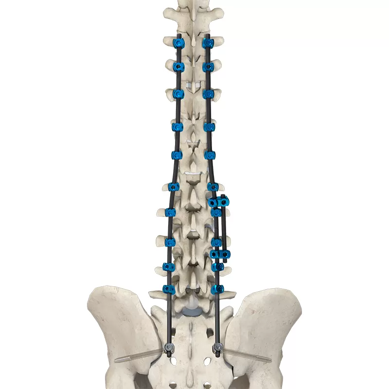 Broken Rod Revision Surgery