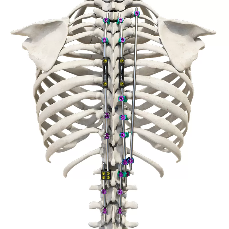 CoCrMo Posterior Thoracolumbar Spinal System 4.5(for children)