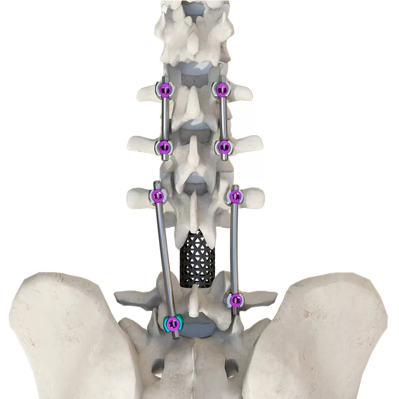 CoCrMo Posterior Thoracolumbar Spinal System 4.5(for children)