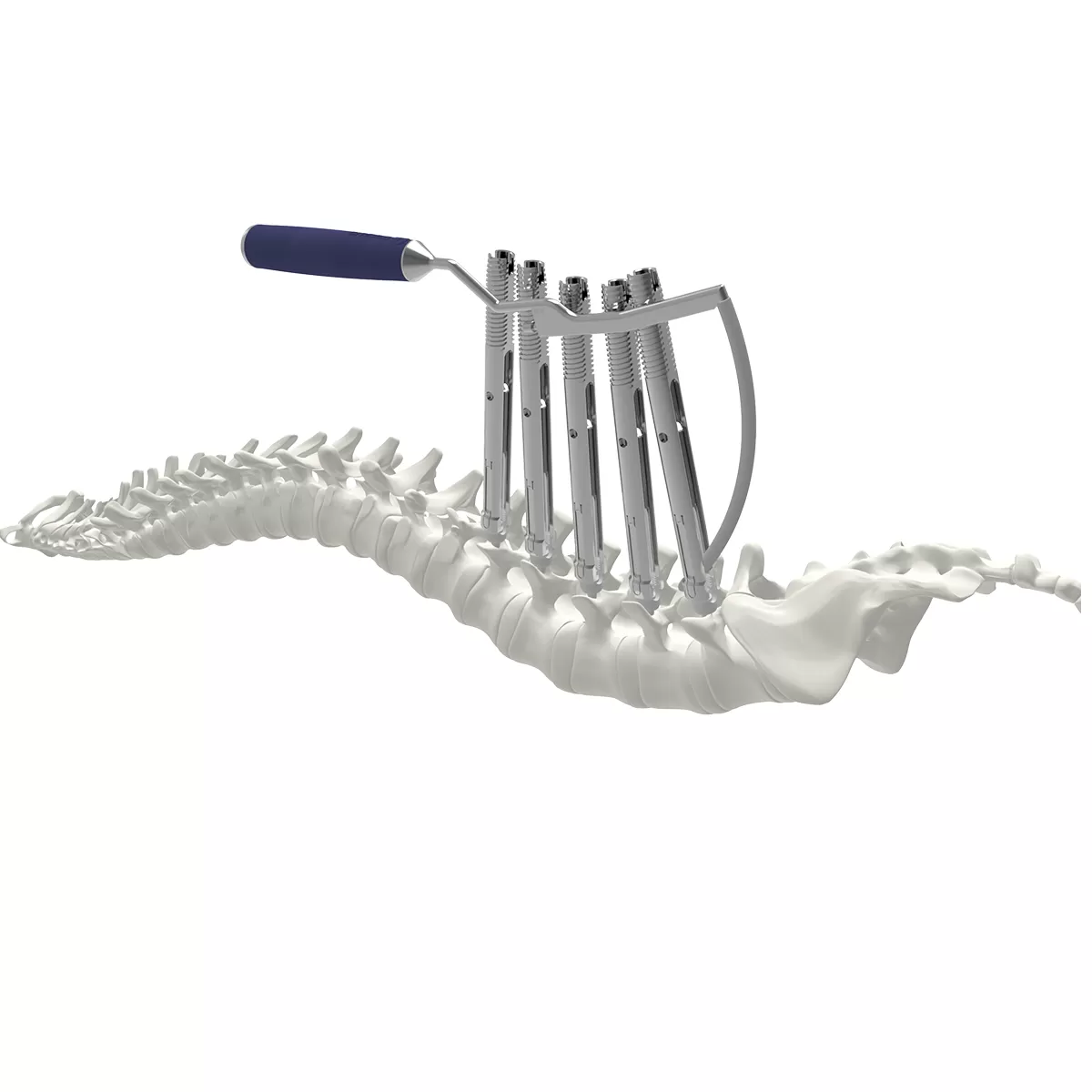 6.0/6.35 mm percutaneous TL screw-rod fixation Instruments (rigid)