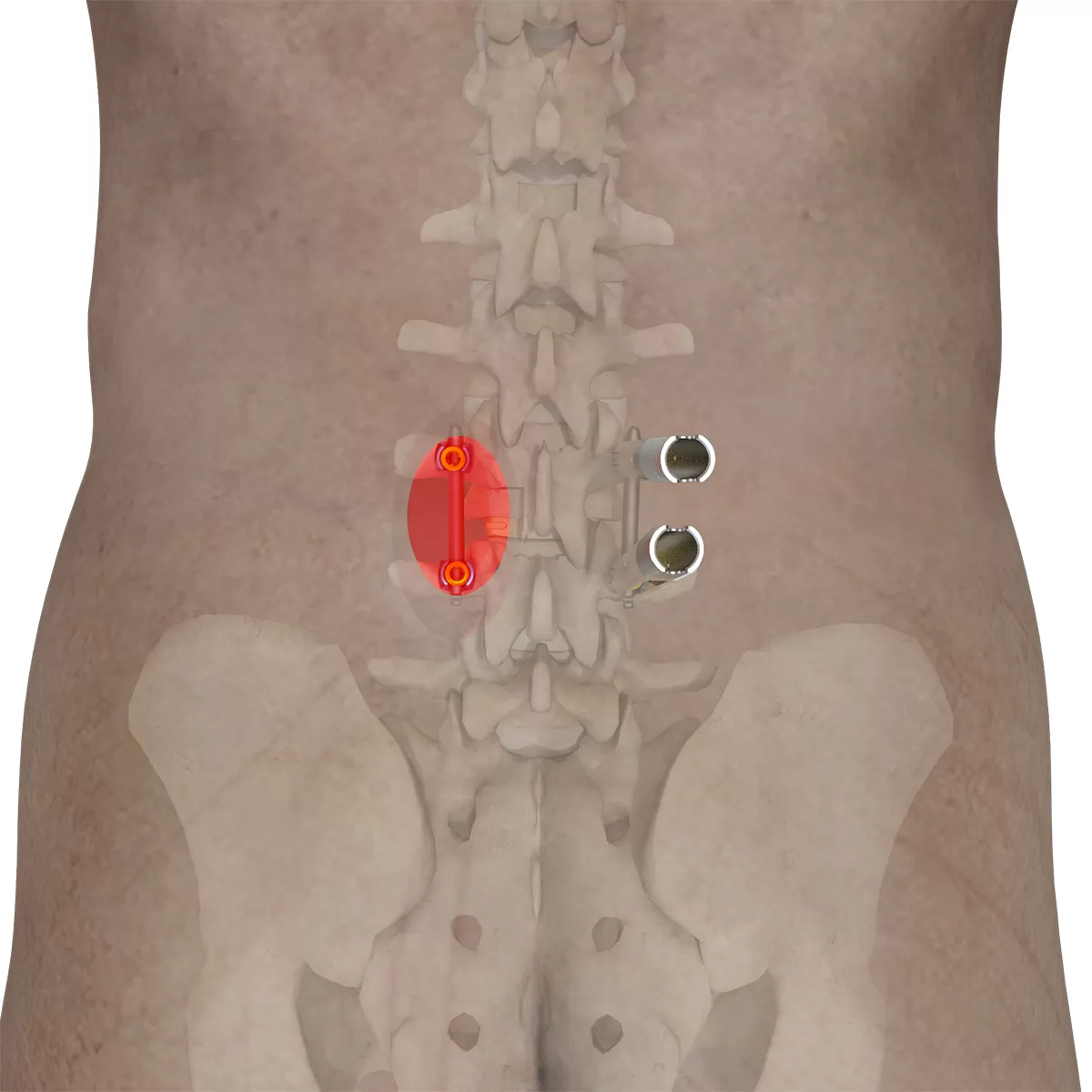 6.0/6.35 mm percutaneous TL screw-rod fixation Instruments (rigid)