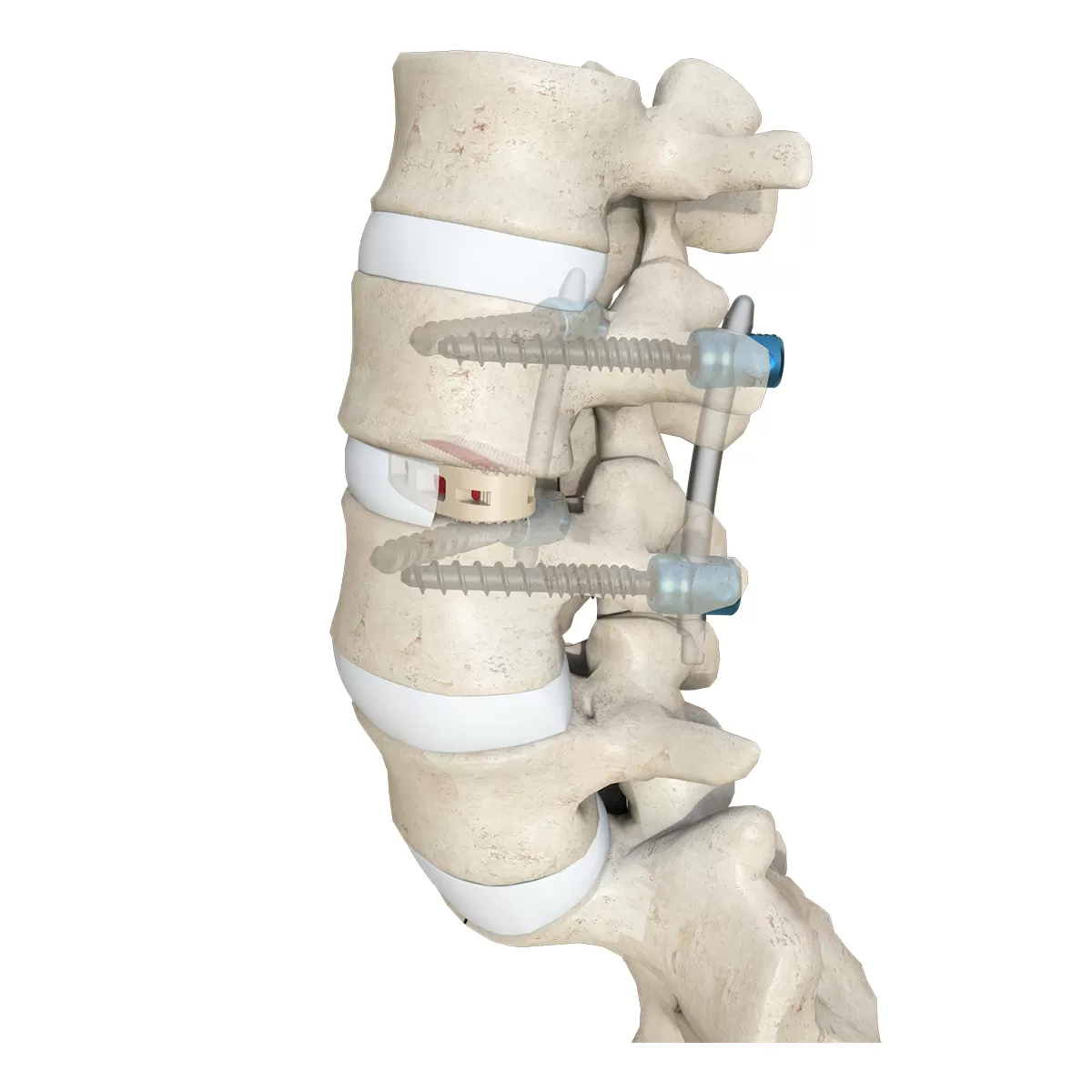 OLIF Cage Instrument Set - Disc Preparation