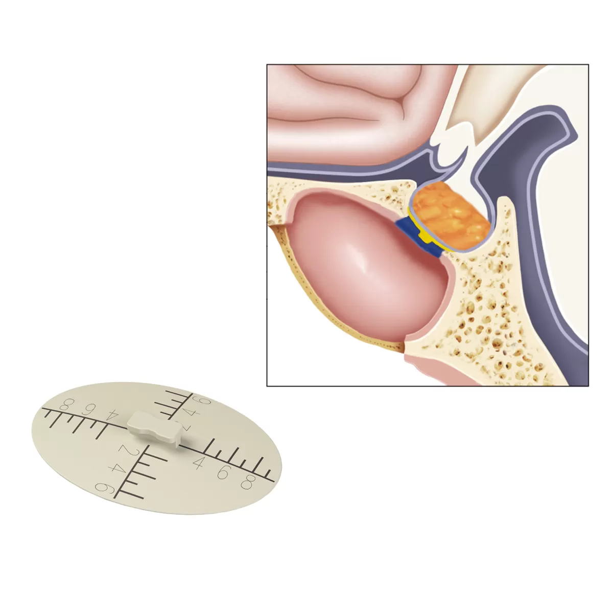 Transsphenoidal Sellar lmplant