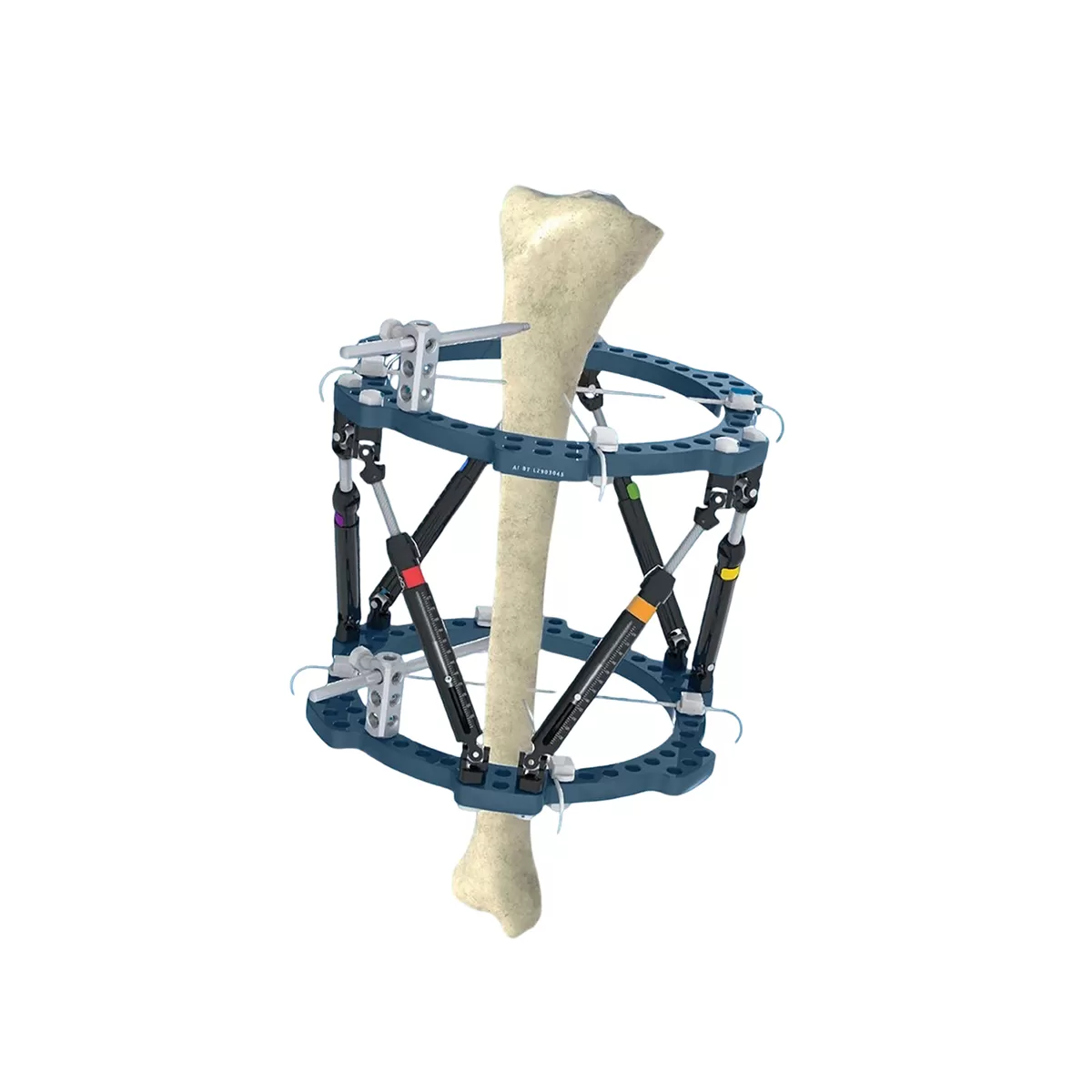 3D External Fixator