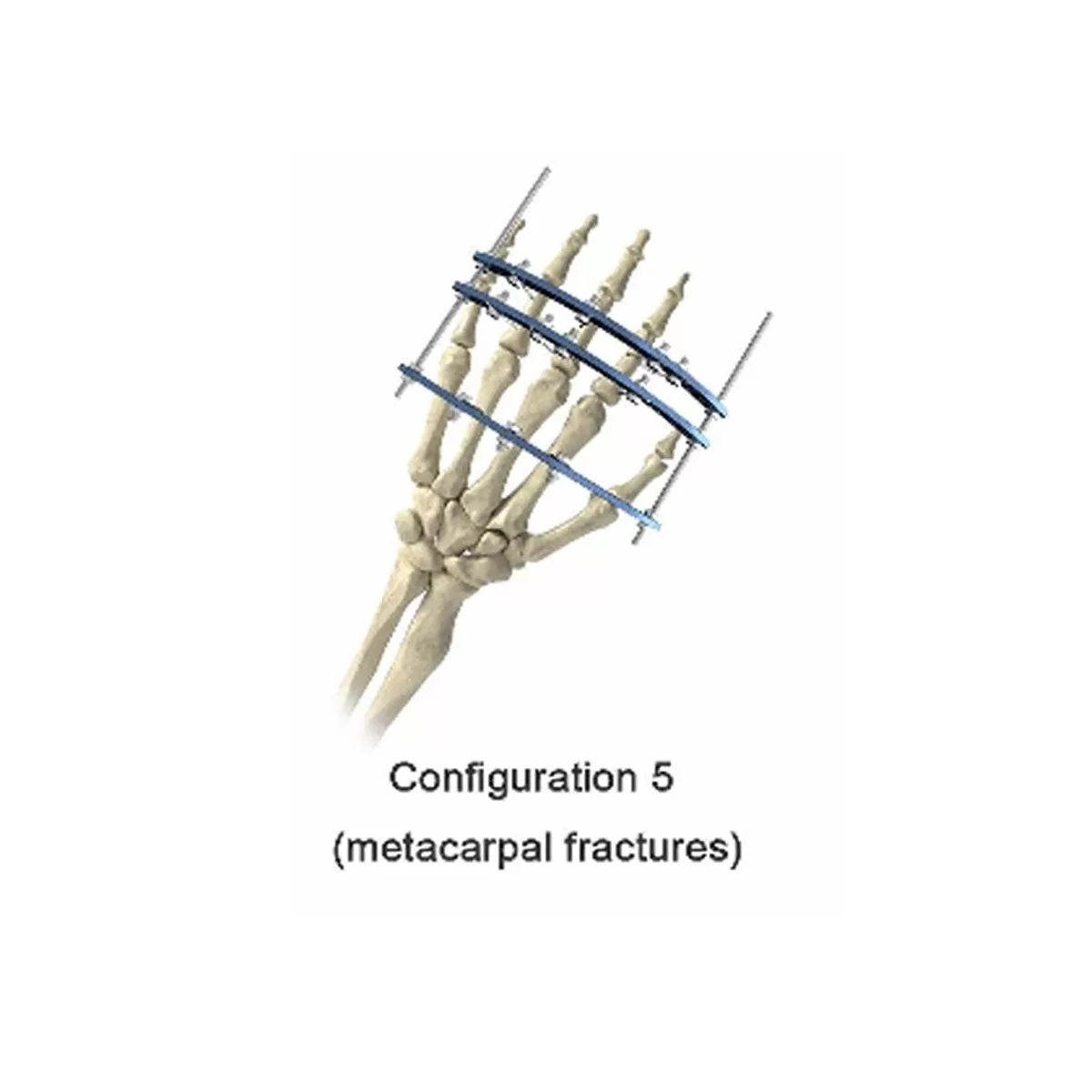 Phalanx External Fixator