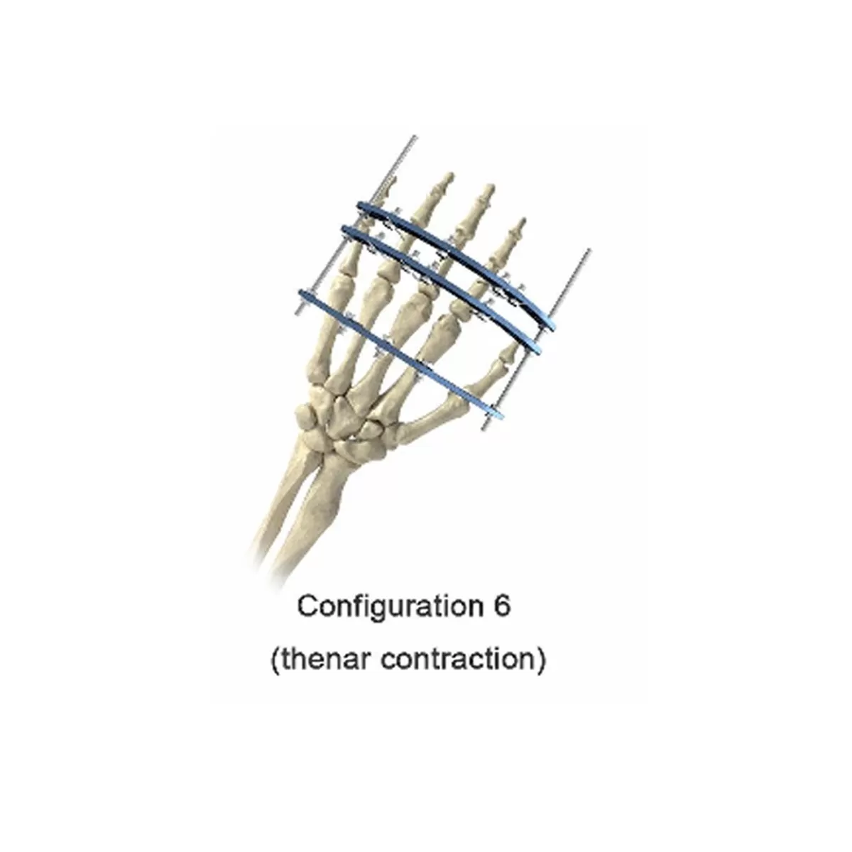 Phalanx External Fixator