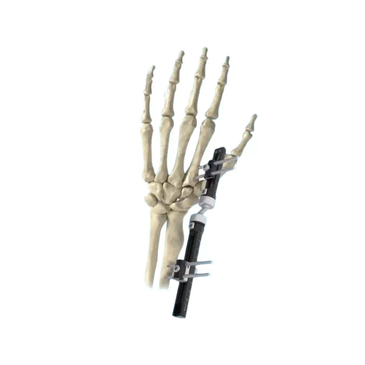 Wrist External Fixator