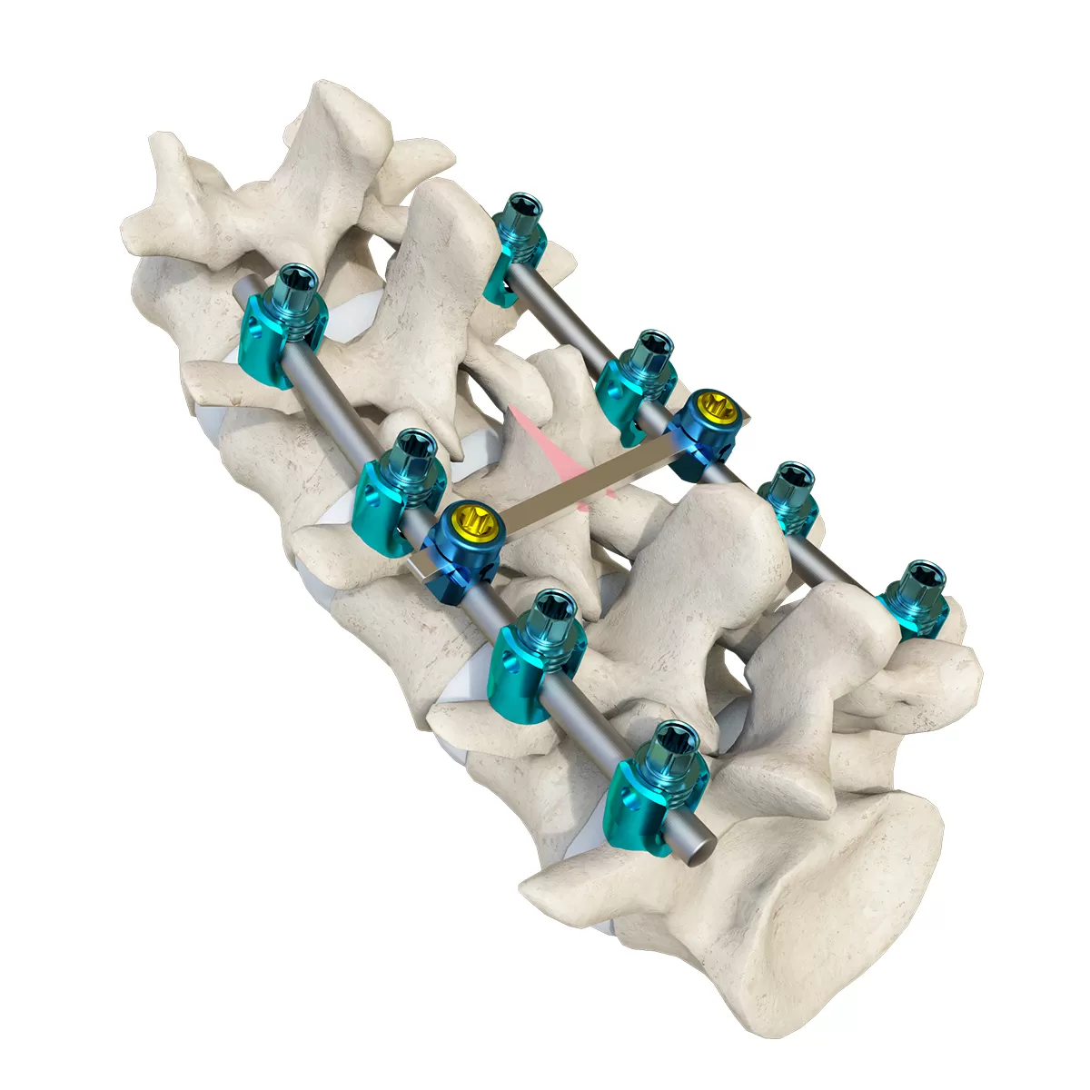 Luna Posterior Thoracolumbar Spinal System