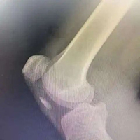 Suture Anchor Fixation for Inferior Pole Patellar Fractures