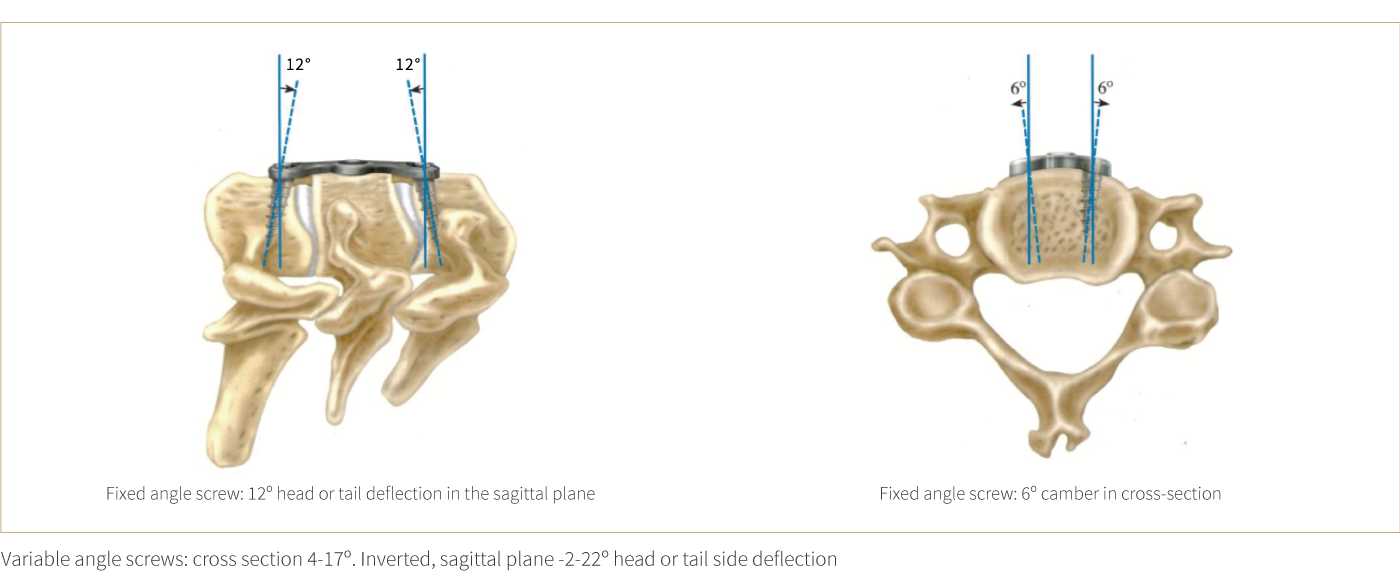 Anterior Cervical Plate – Type III