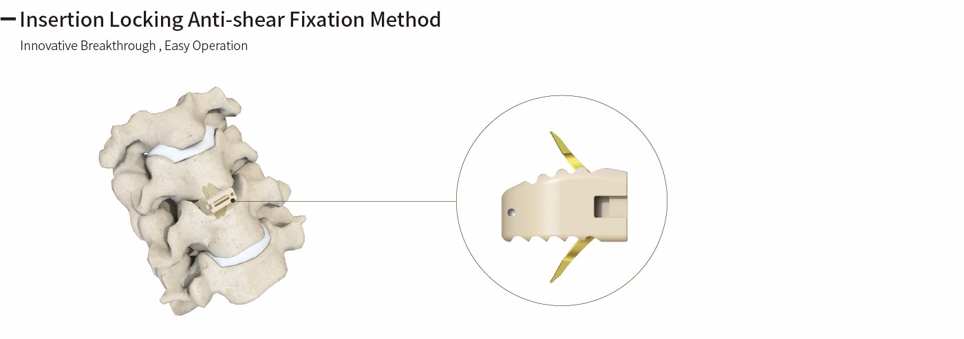 Cervical Interbody Fusion Cage (Insert-type)