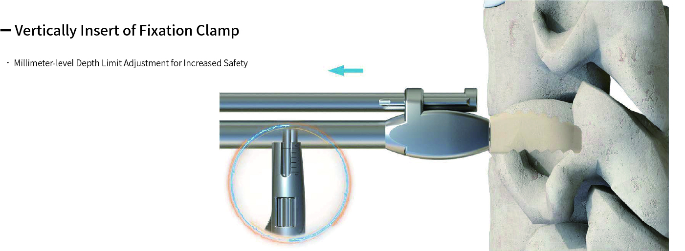 Cervical Interbody Fusion Cage (Insert-type)
