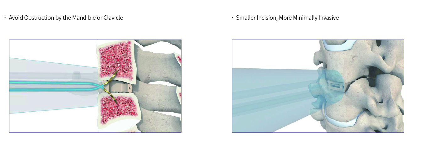 Cervical Interbody Fusion Cage (Insert-type)