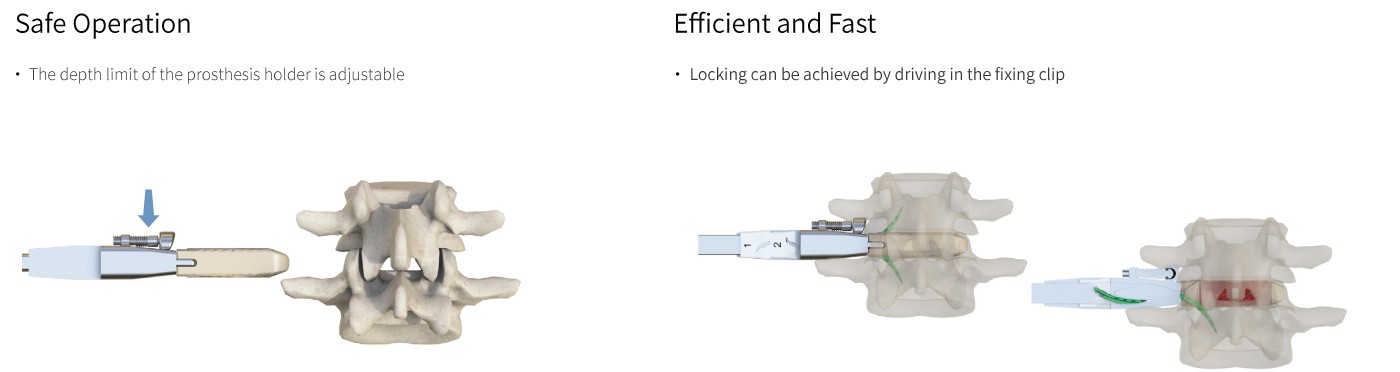 Self-Stabilizing Lumbar Interbody Fusion Cage Uni-L