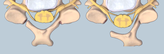 Lamina Fixation System Lamina Fixation System