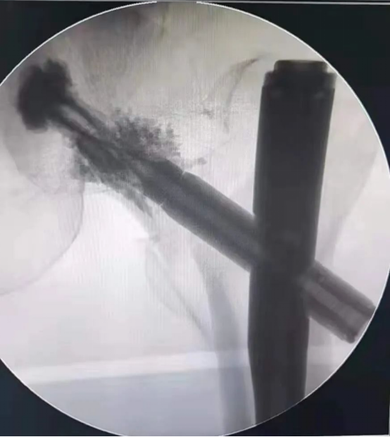 Atom Medical PFNA with Bone Cement Postoperative AP View