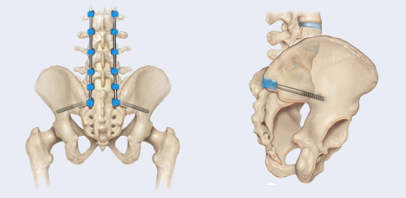 Thoracolumbar Percutaneous Screw & Rod System - Sacroiliac