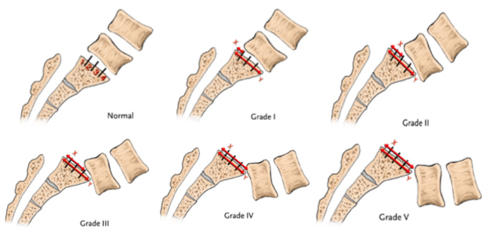 Meyerding classification